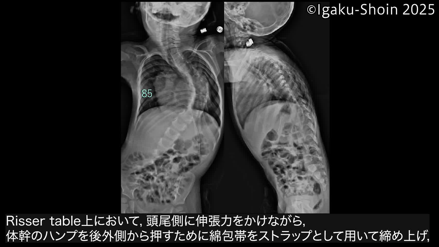 動画1　側弯矯正ギプスの実際
