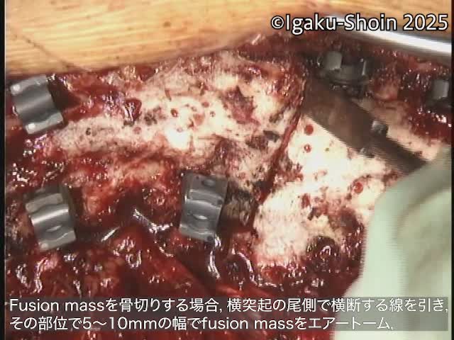 動画4　ノミを使ったfusion mass osteotomy