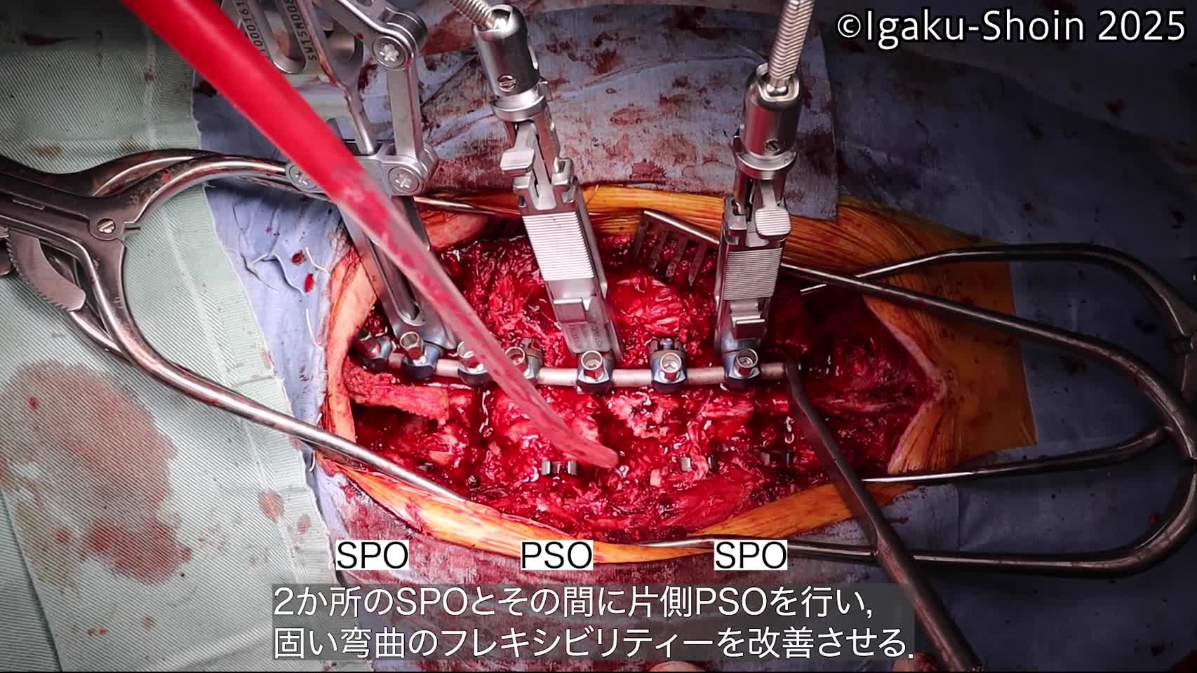 動画9　固い上位胸椎弯曲（先天性側弯）に対する片側PSOとSPO併用とロッド回旋操作による側弯矯正...