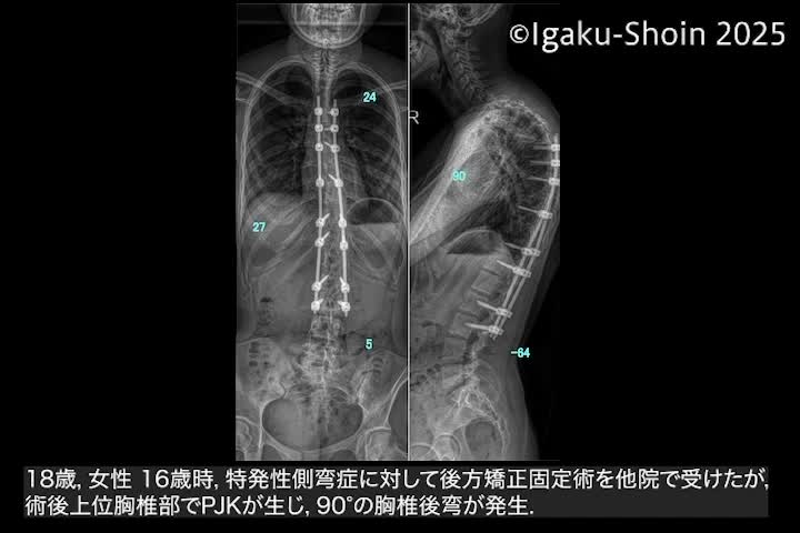 動画10　3か所のPSO骨切り後に両側ロッド設置してcantilever操作で行った後弯矯正...