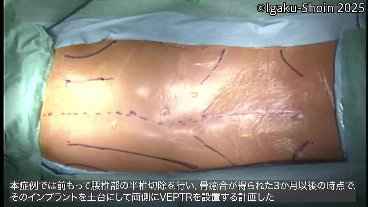 動画11　肋骨癒合を伴う先天性側弯症に対するVEPTR手術...
