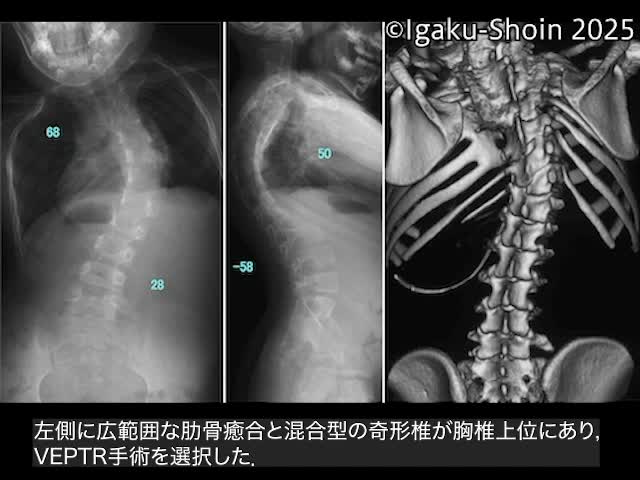 動画12　肋骨癒合を伴う先天性側弯症に対するVEPTR手術...