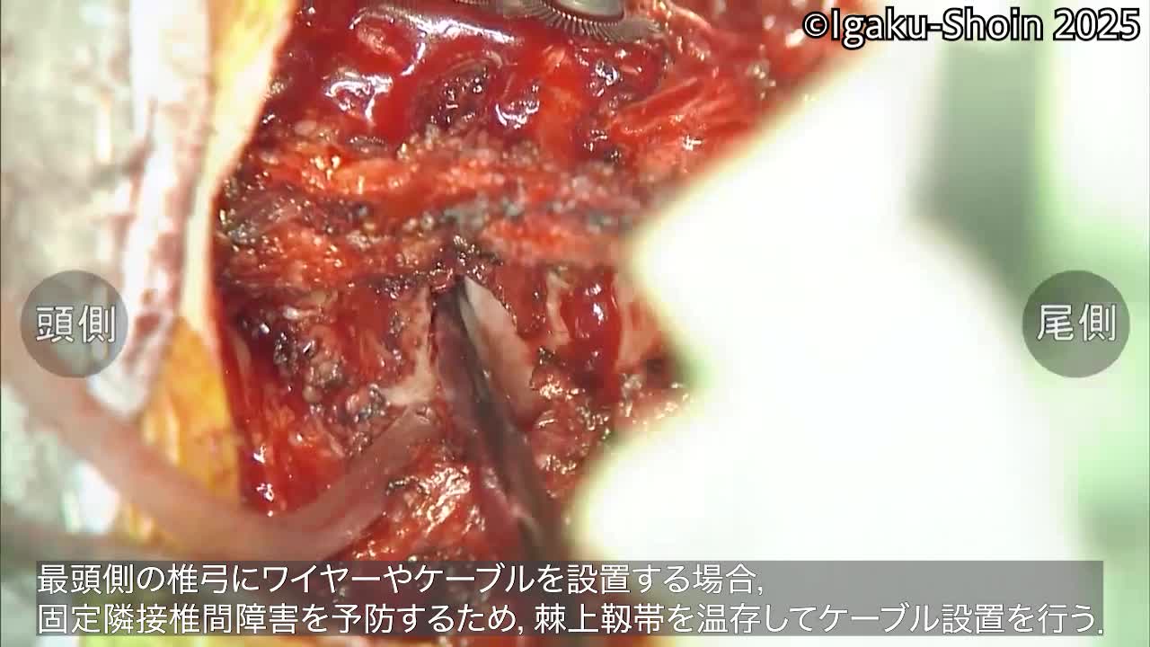 動画15　ネスプロンケーブルの設置と固定の補強...
