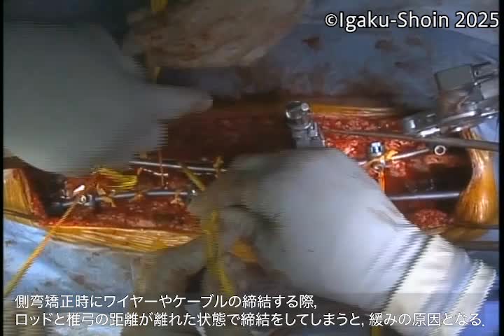 動画16　側弯矯正におけるCable締結時のポイント...