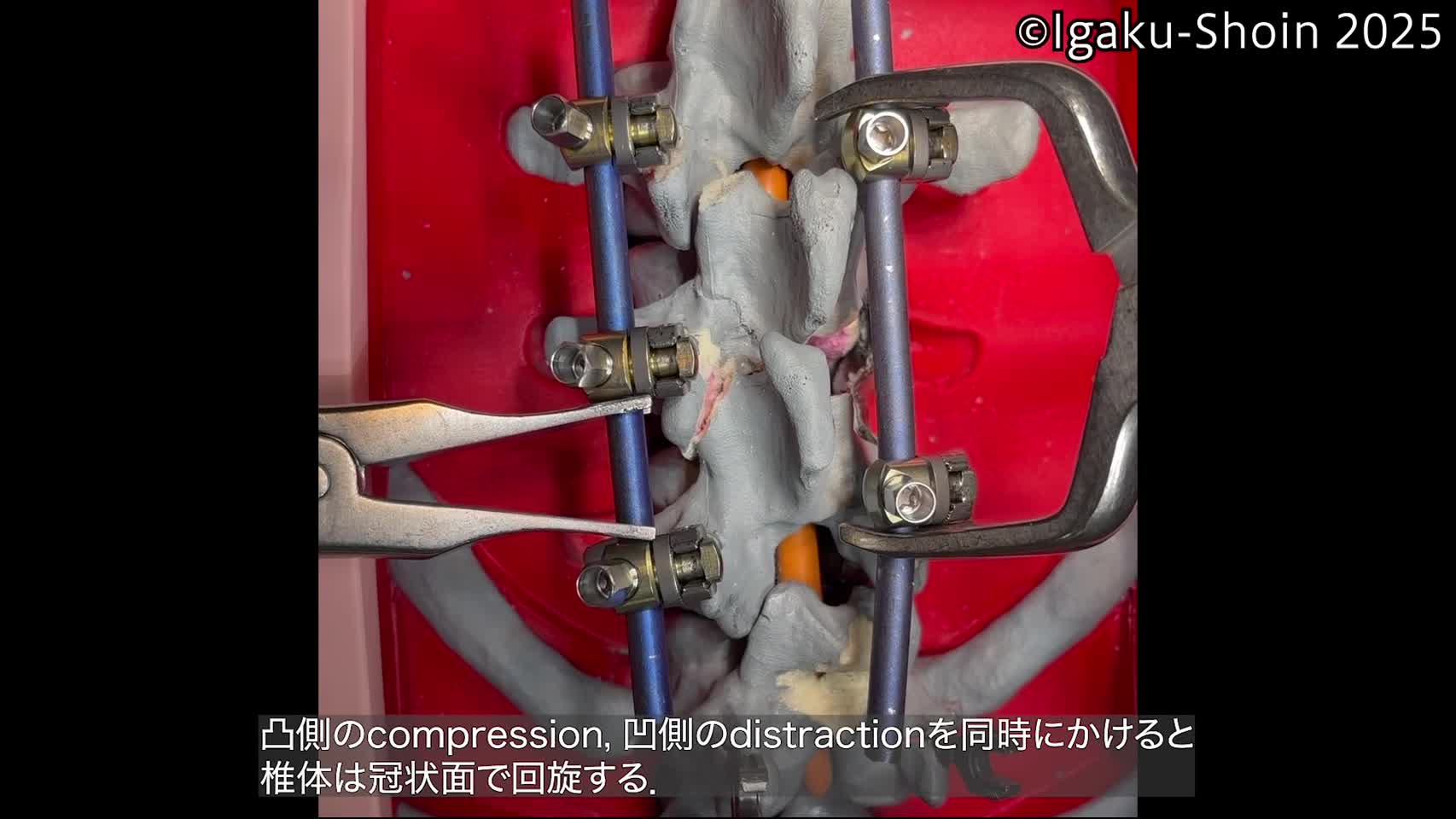 動画17　Compressor とdistractorを使用した局所の矯正...