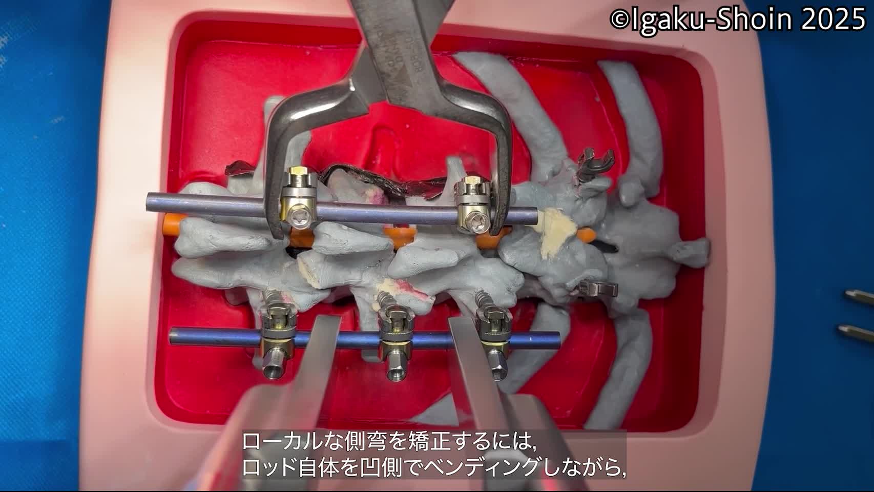 動画18　Bridge bender（L-bender)とcompressorの併用による追加矯正...