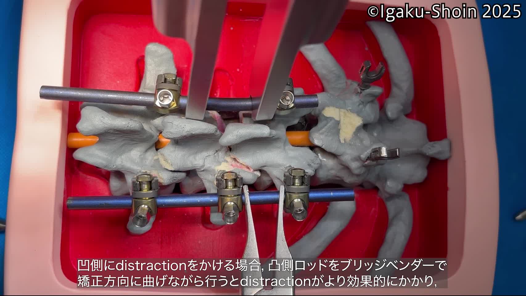 動画19　Bridge bender（L-bender）と spreaderの併用による追加矯正...