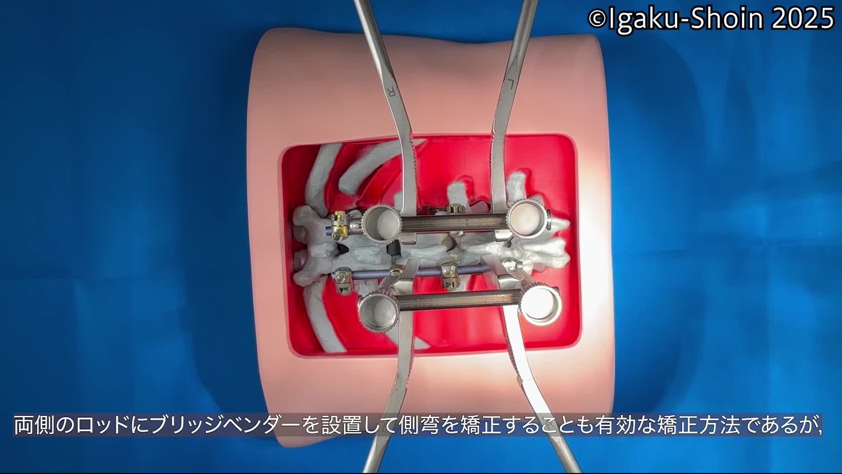動画20　両側にBridge Benderを使用した側弯矯正...