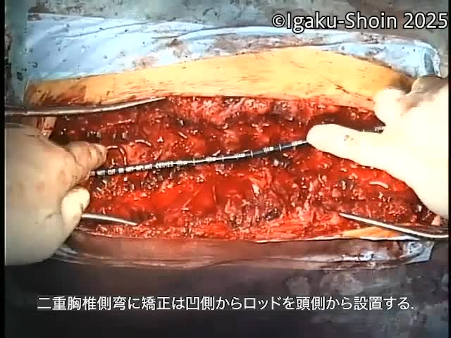 動画21　Lenke type 2に対する実際の手術