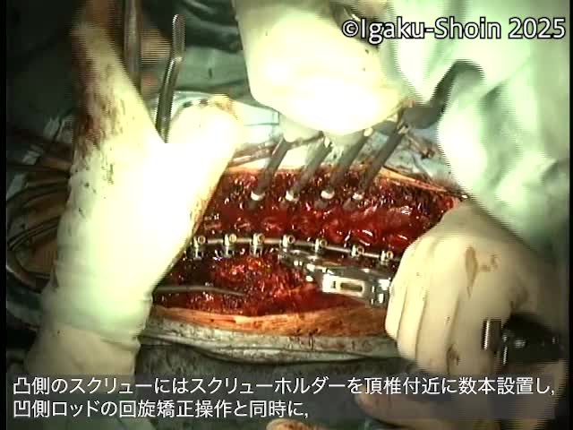 動画22　Direct Vertebral Rotation
