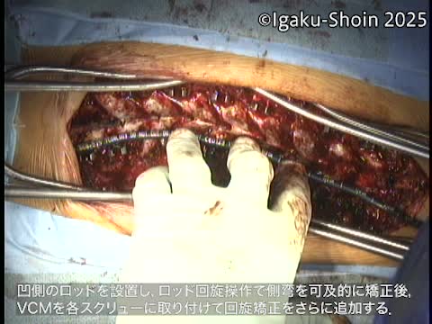 動画23　凹側ロッド回旋操作とVertebral Collum Manipulation (VCM)...