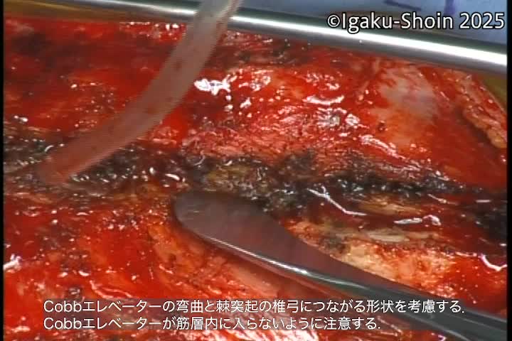 動画24　Intrasacral fixationの手術手技