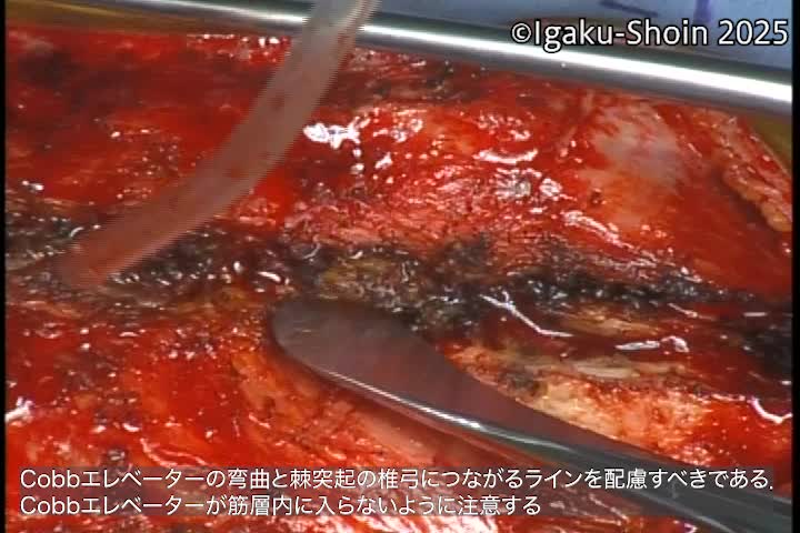 動画25　Cobb エレベーターの使い方；棘突起から筋を剥離するやり方...