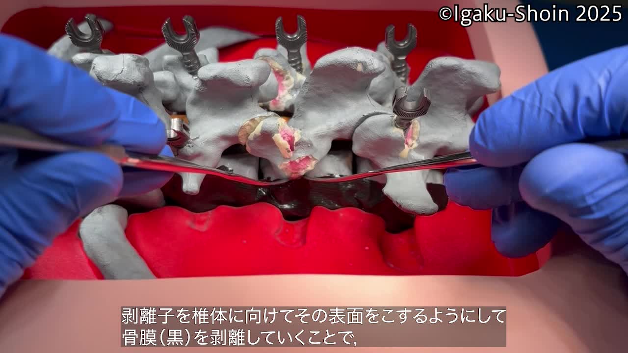 動画26　剥離子を使った椎体骨切りの際に行う骨膜剥離操作①...