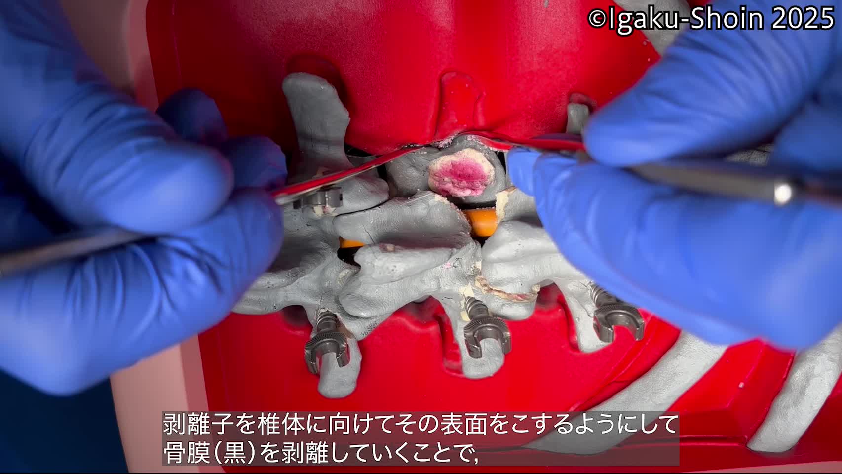 動画27　剥離子を使った椎体骨切りの際に行う骨膜剥離操作②...