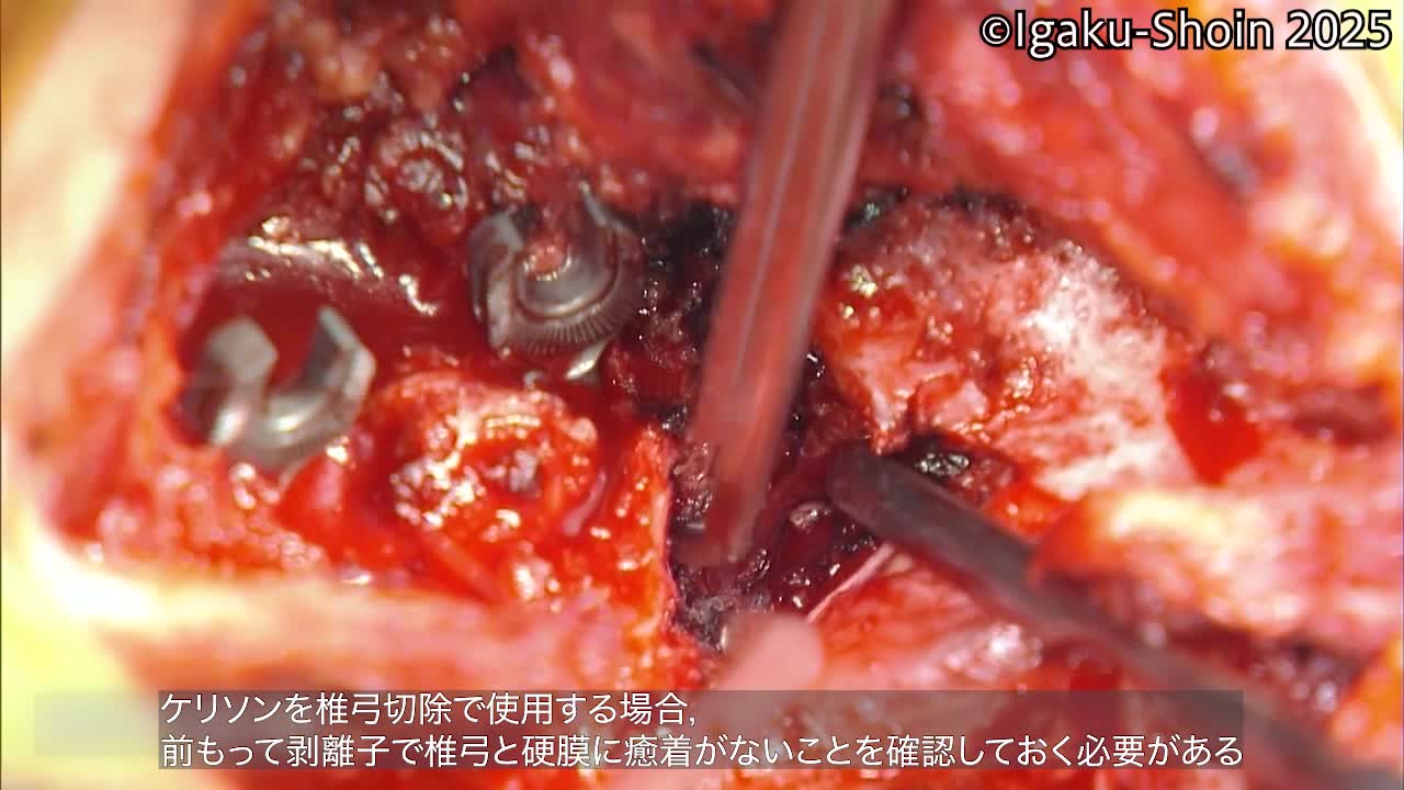 動画29　ケリソン鉗子の使い方