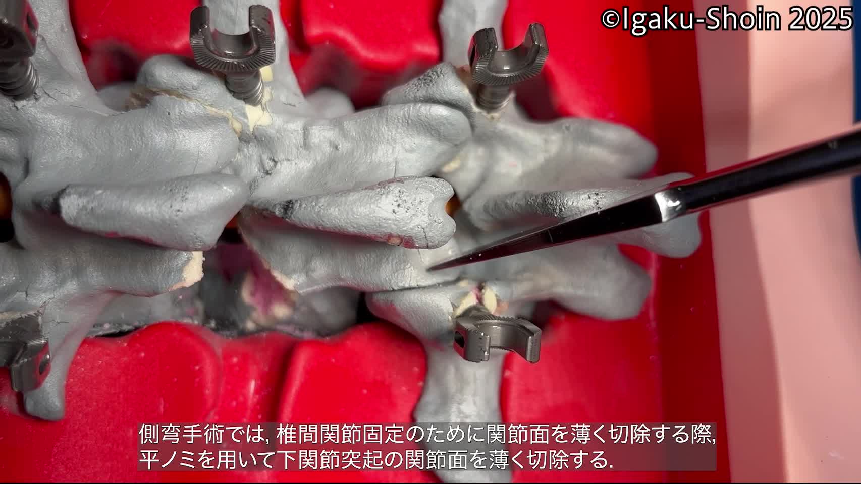 動画33　誤った鋭匙の使い方