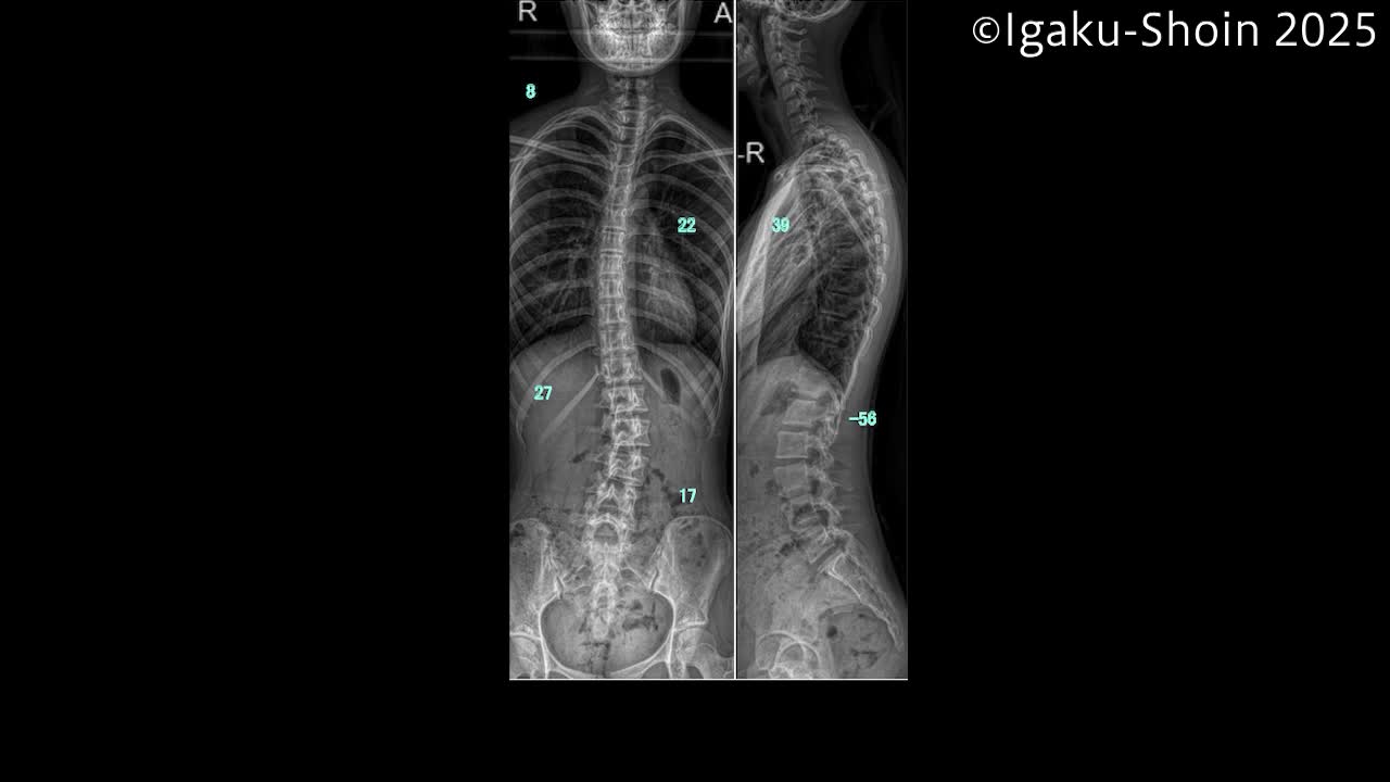 動画38　Corrective PLIFの手術 
