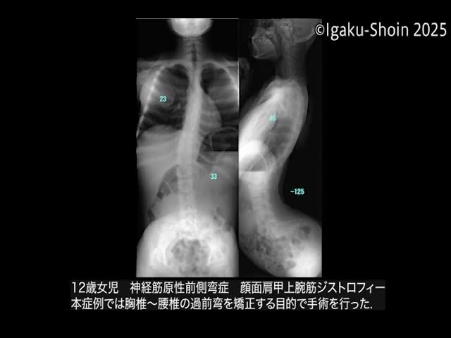 動画39　半椎に対する後方からの摘出操作...