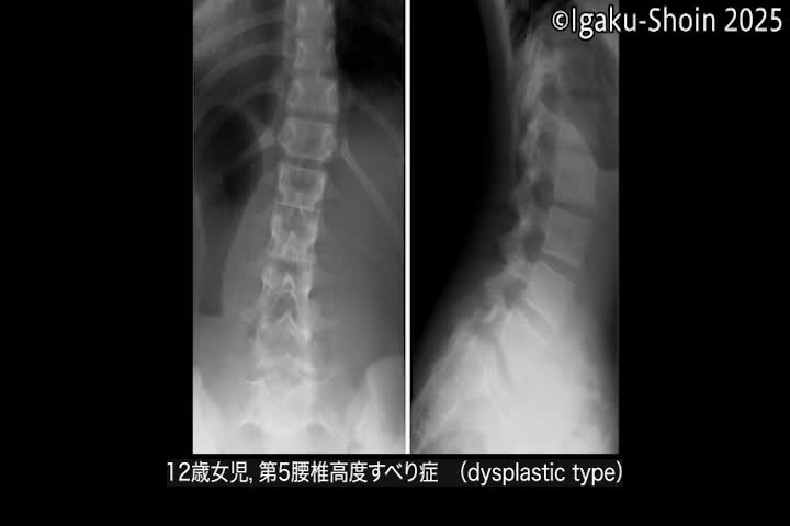 動画41　ケーブルを使用した側弯矯正